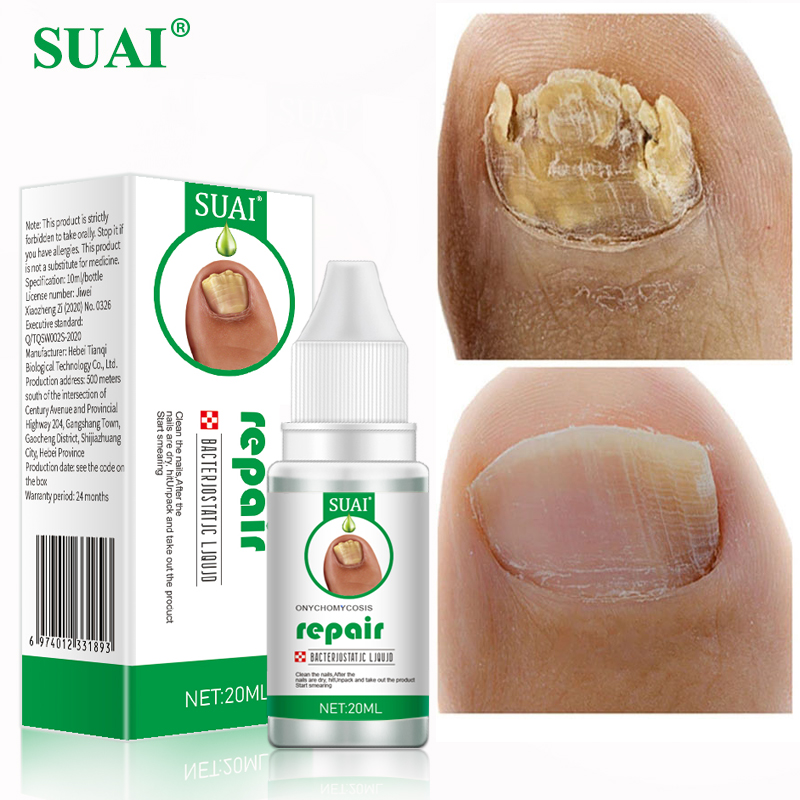Nail Fungus Treatment Feet Care Essence Anti Infection Paronychia Onychomycosis Nail Foot Toe Nail Fungal Removal Gel Products